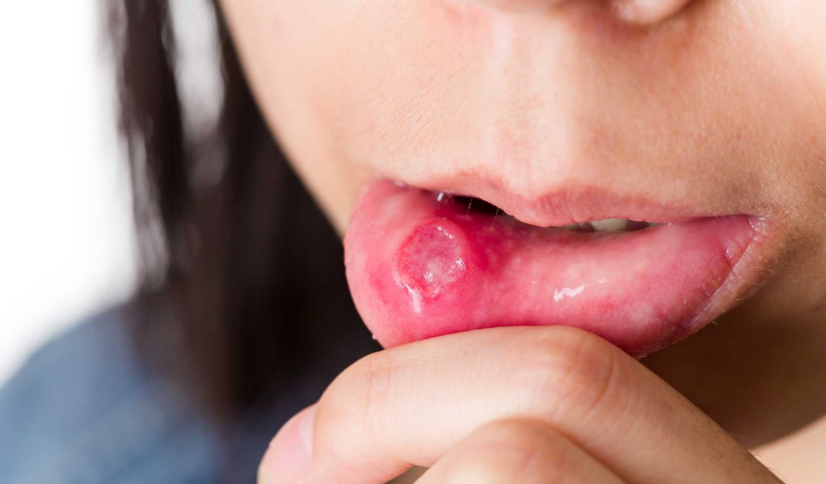 Герпес на губе и другие типы герпетической инфекции