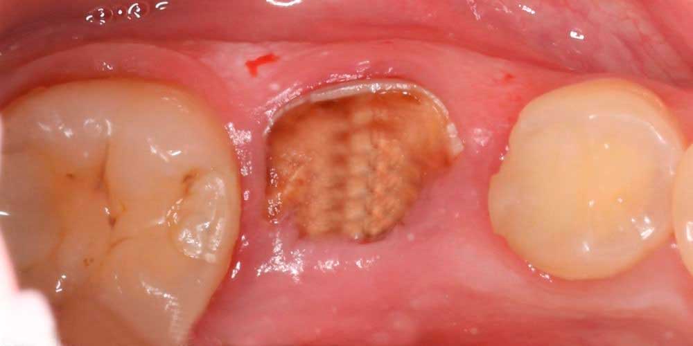 Примеры работ Удаление Зубов